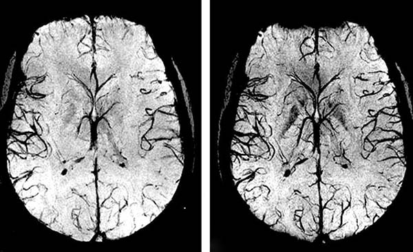 Smadzenes un insults