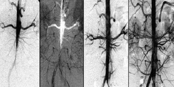 Asinsvadi un hipertensija